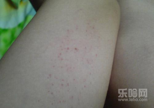 紫癜前期症状有哪些,紫癜的早期症状-乐哈健康