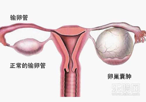 卵巢囊肿手术后多久可以同房,卵巢囊肿微创手