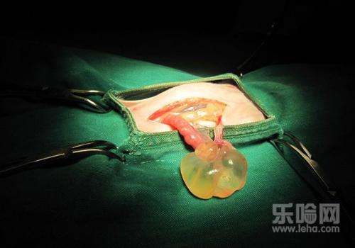 卵巢囊肿手术后多久可以同房,卵巢囊肿微创手