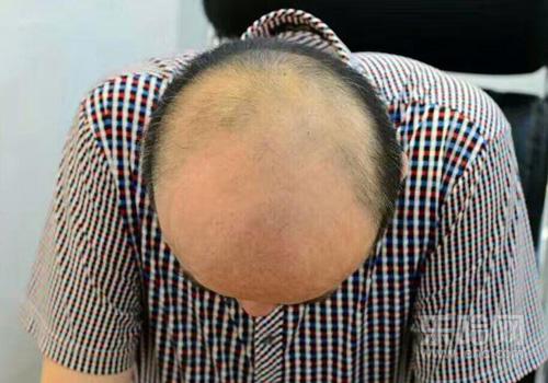 种植头发有什么害处,种植头发的危害,种植头发