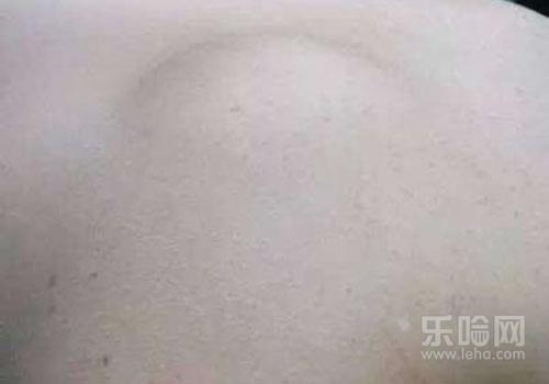 脂肪瘤疼痛是怎么回事,脂肪瘤痛是怎么回事,脂