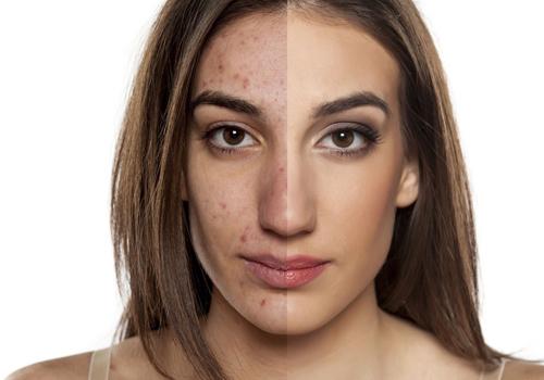 盆腔炎附件炎吃什么药效果好 安全又健康的食