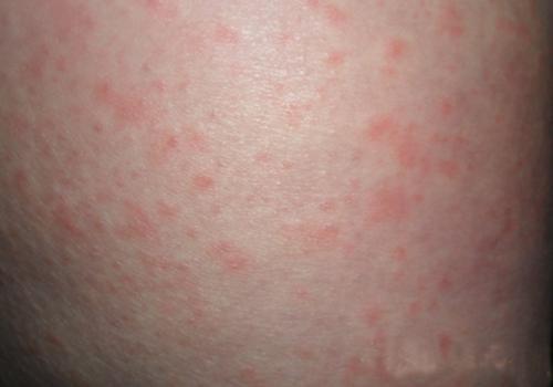 全身痒有时针刺一样 这些疾病要引起重视