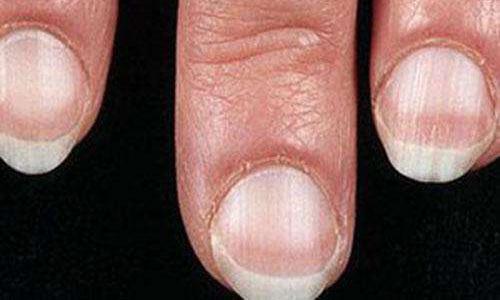 林赛氏指甲是什么 林赛氏指甲图片