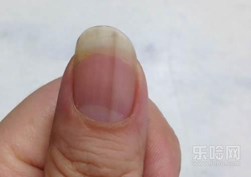 指甲上有黑色竖纹怎么办,指甲上有黑色竖纹怎