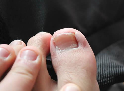 脚趾甲凹陷是怎么回事,脚趾甲凹陷是什么原因-乐哈健康网