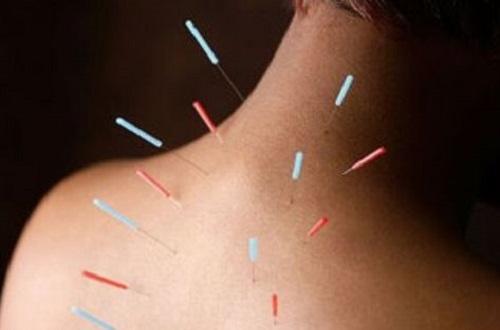 针灸对颈椎病有用吗,颈椎病针灸哪些部位