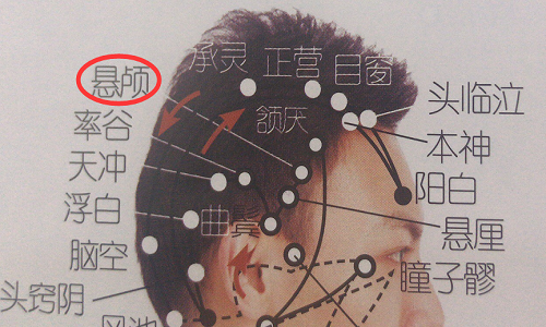 悬颅的准确位置图悬颅准确位置图和作用