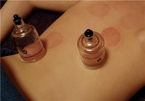 拔罐拔出血是怎么回事 拔罐出血怎么办