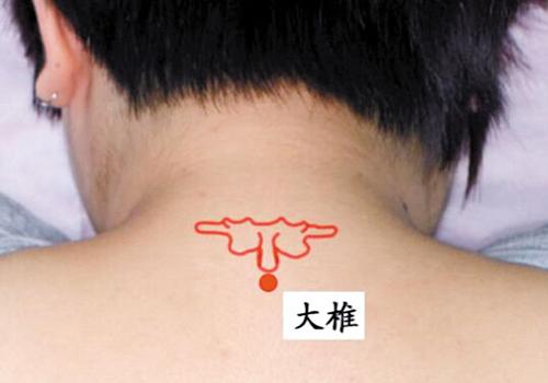 三伏贴能治颈椎病吗 三伏贴贴哪里缓解颈椎病