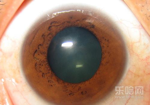 眼睛玻璃体混浊是怎么回事,玻璃体浑浊是怎么引起的-乐哈健康网