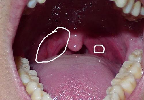 喉咙有异物咳不出来咽不下去是怎么回事,该怎么办