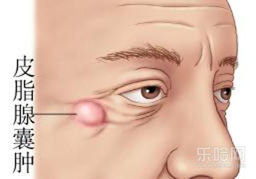 皮下囊肿是怎么形成的
