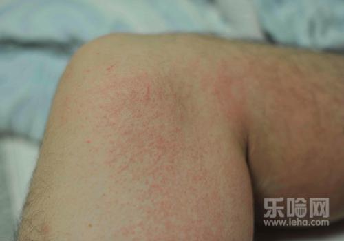 湿疹有几种类型和图片