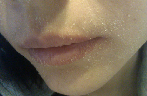 皮肤缺水引起脱皮