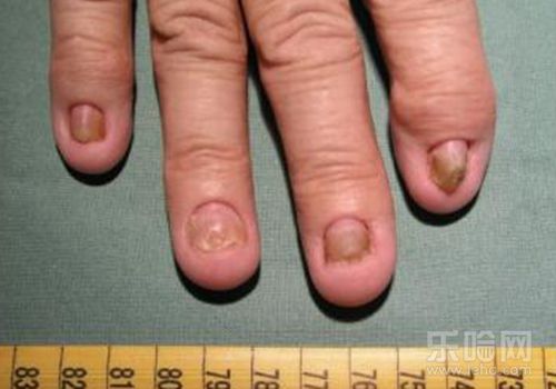 甲营养不良是什么